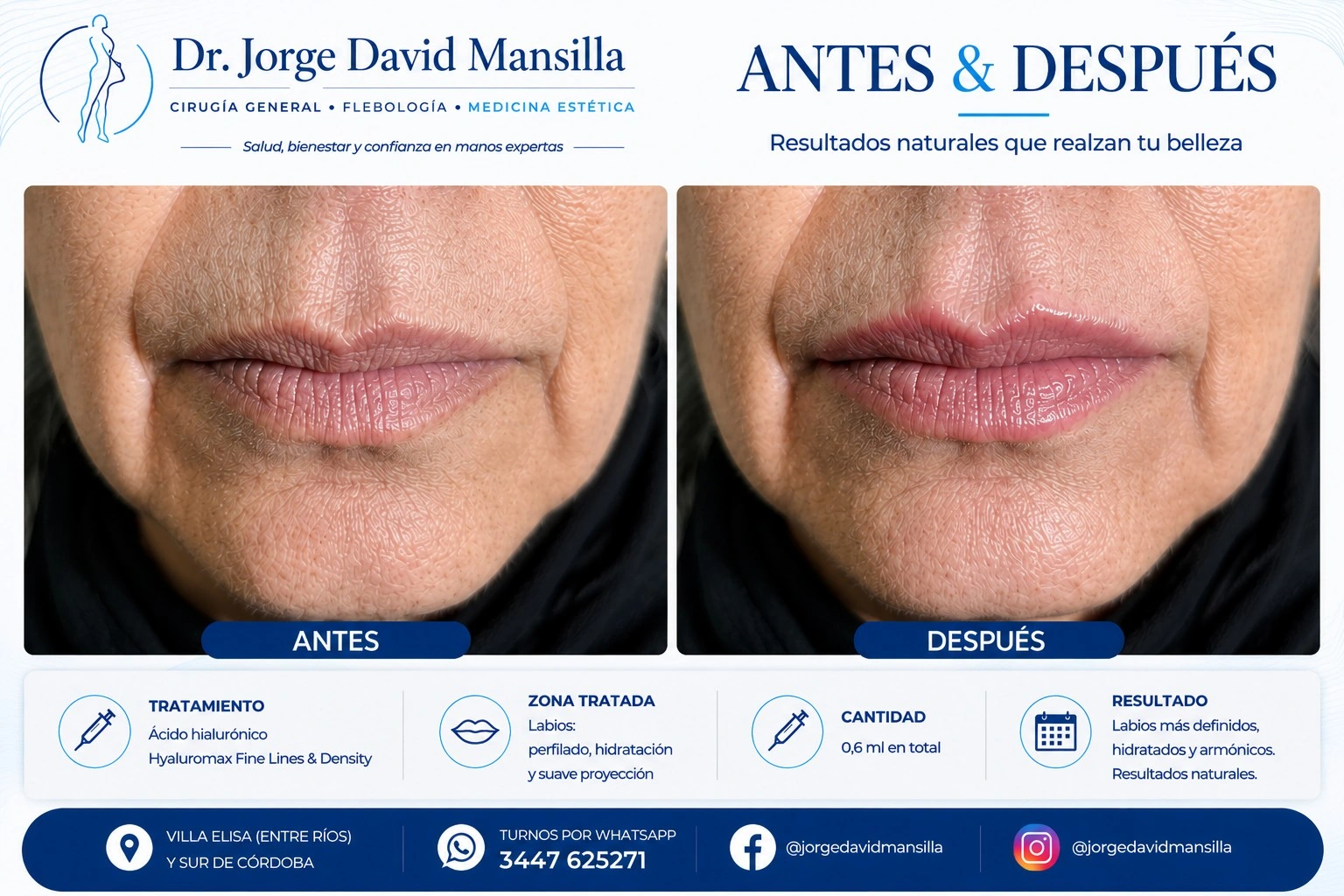 Antes y después de tratamiento de labios