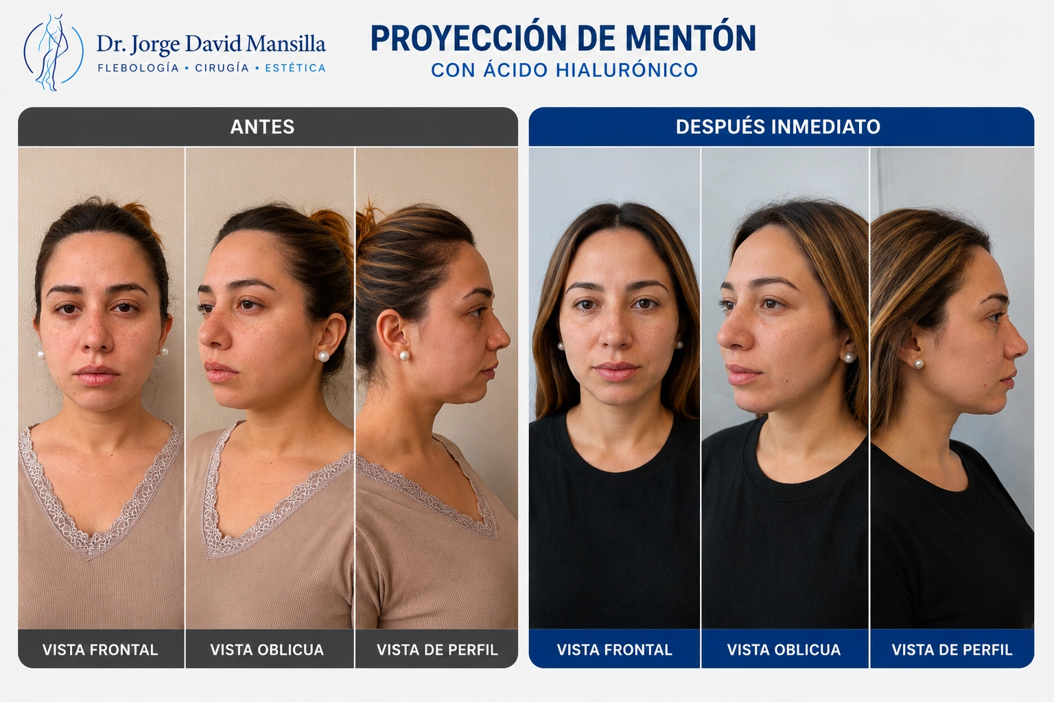Antes y después de proyección de mentón