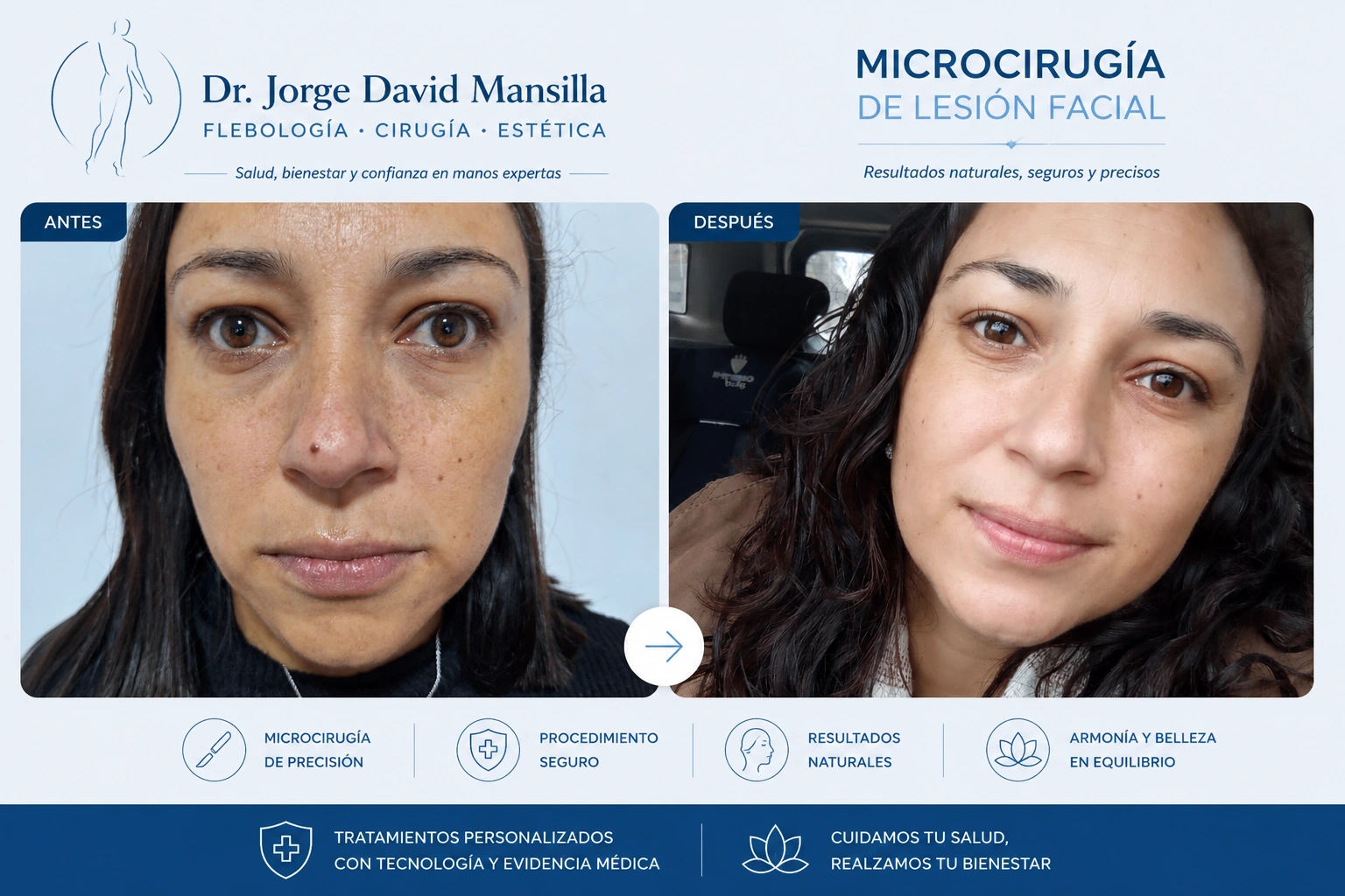Antes y después de microcirugía de lesión nasal