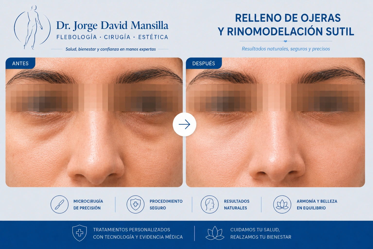 Relleno de ojeras y rinomodelación sutil - antes y después
