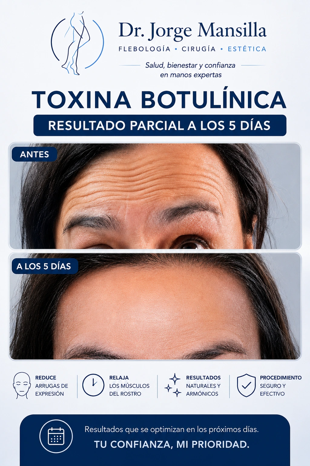 Antes y resultado parcial a los 5 días de toxina botulínica